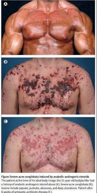 Die besten 100 Bilder in der Kategorie schlimme_sachen: Schwere Akne verursacht durch Anabolische Steoride - Anabolika Missbrauch