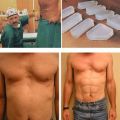 The Best Pics:  Position 89 in  - Funny  : Sixpack-Implantate