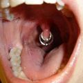 The Best Pics:  Position 90 in  - Funny  : Extreme Piercing an Gaumen-Zäpfle