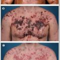 Die besten Bilder in der Kategorie Vote: Schwere Akne verursacht durch Anabolische Steoride - Anabolika Missbrauch
