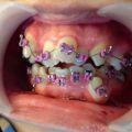 The Best Pics:  Position 6 in  - askant teeth, brace